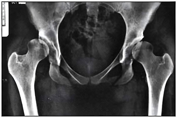 X-ray showing severe acetabular dysplasia