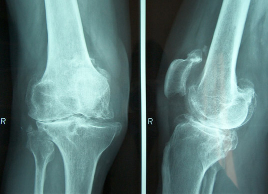 X-ray showing knee arthritis