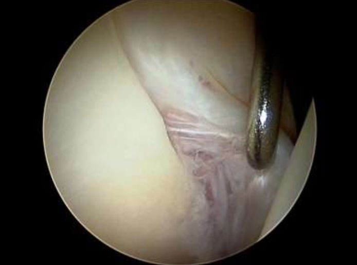 View during hip arthroscopy