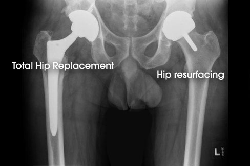 Total Hip Replacement vs Hip Resurfacing