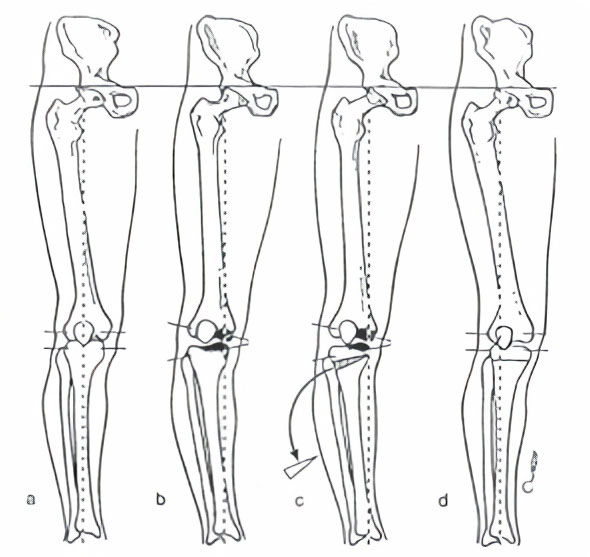 Diagram of knee osteotomy
