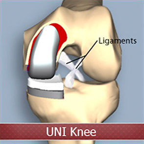 Diagram of knee osteotomy