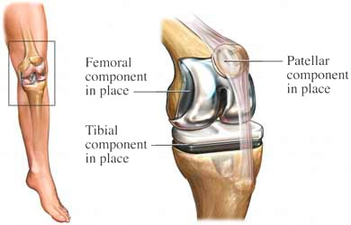 Diagram of knee replacement components