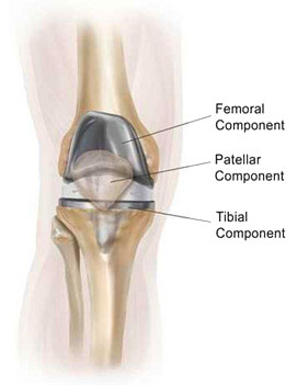 Diagram of knee replacement components