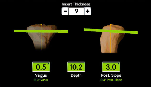 Diagram of knee osteotomy